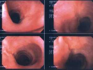 GYZYLÖDEGIŇ  RAK  KESELI