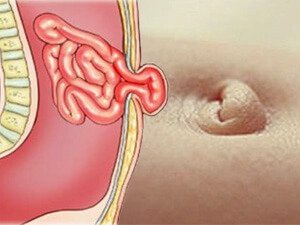 GÖBEK INGISI: SEBÄPLERI, ÇAGALARDA WE ULULARDA BEJERILIŞ AÝRATYNLYKLARY