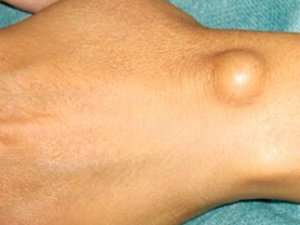 GIGROMA KESELI ÇAGALARDA WE ULY ADAMLARDA: SEBÄBI, ALAMATLARY, BEJERGISI