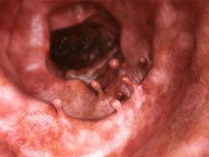 GÖNI IÇEGÄNIŇ RAK KESELI BARADA NÄMELER BILMELI?