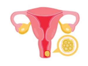 ÝATGYNYŇ BOÝUNJYGYNYŇ RAK KESELINIŇ ÖŇÜNI ALMAK, ÝÜZE ÇYKARMAK WE BEJERMEK ÜÇIN TÄZE GÖRKEZMELER