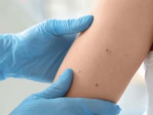 DERINIŇ RAK KESELI BARADA NÄMELERI BILMELI?