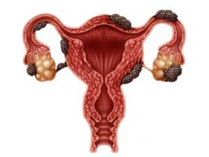 endometrioz