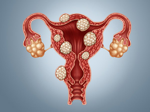 yatgynyn miomasy yumurtgalygyn kistasy